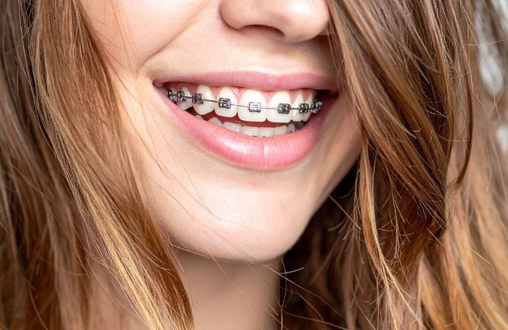 Lee más sobre el artículo Servicio de ortodoncia en Carabanchel: corrige la alineación de tu sonrisa